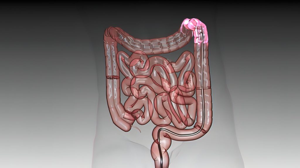 Upper Endoscopy Vs Gastroscopy: Understanding The Differences ...